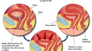 cistite-2